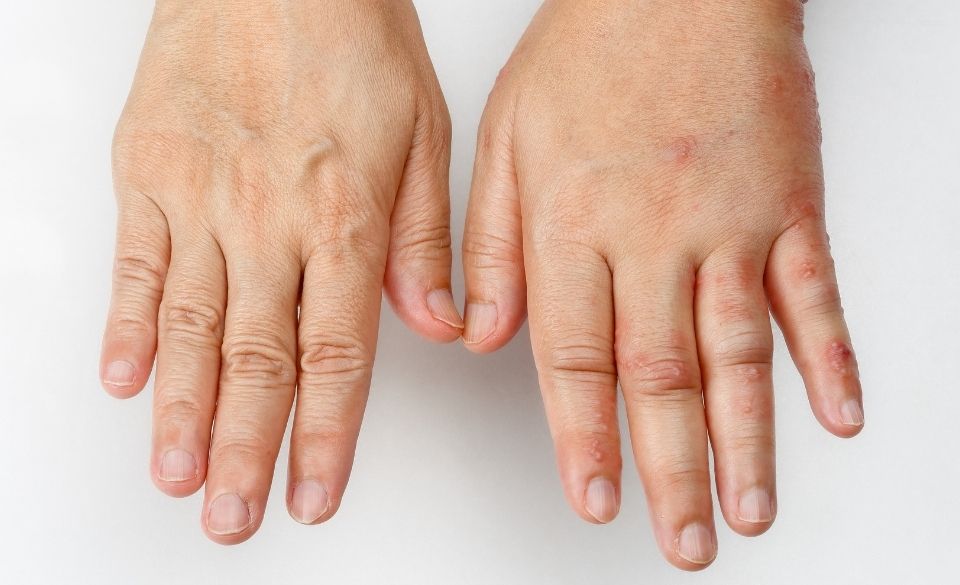 Swollen Hands When Exercising