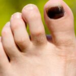Runners Toenail – What Is It? Causes, Treatment and More
