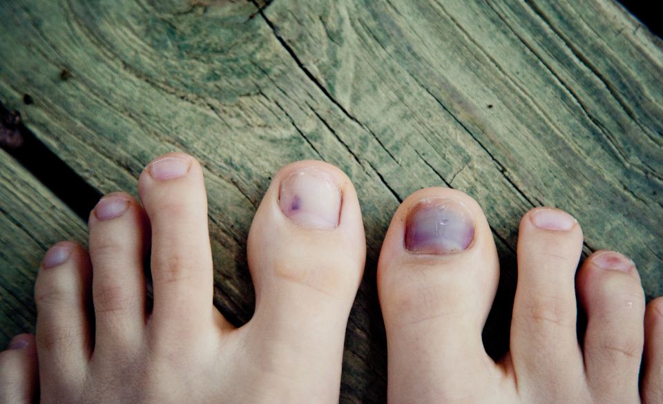 How Long It Takes Bruised Toenails To Heal
