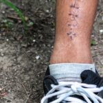 Can You Exercise With Stitches? A Complete Guide