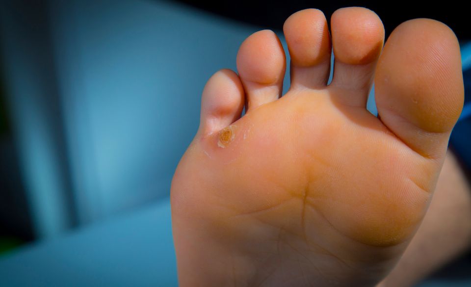 how to prevent calluses on feet