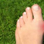 7 Exercises for Relieving Bunion Pain